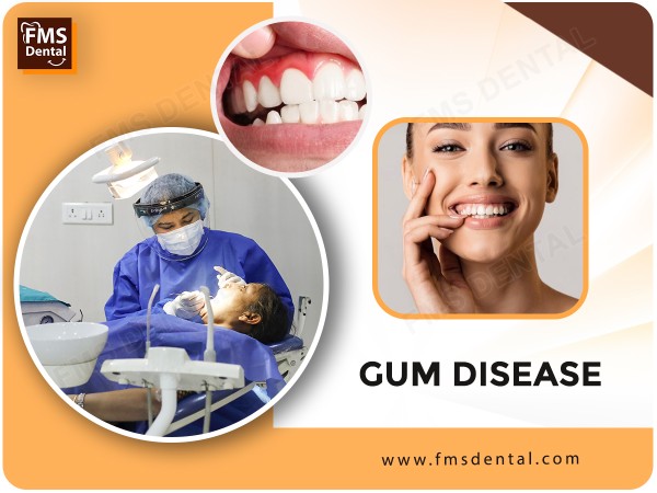 Best Gum specialist in Hyderabad, India, Periodontic treatment in Hyderabad, India