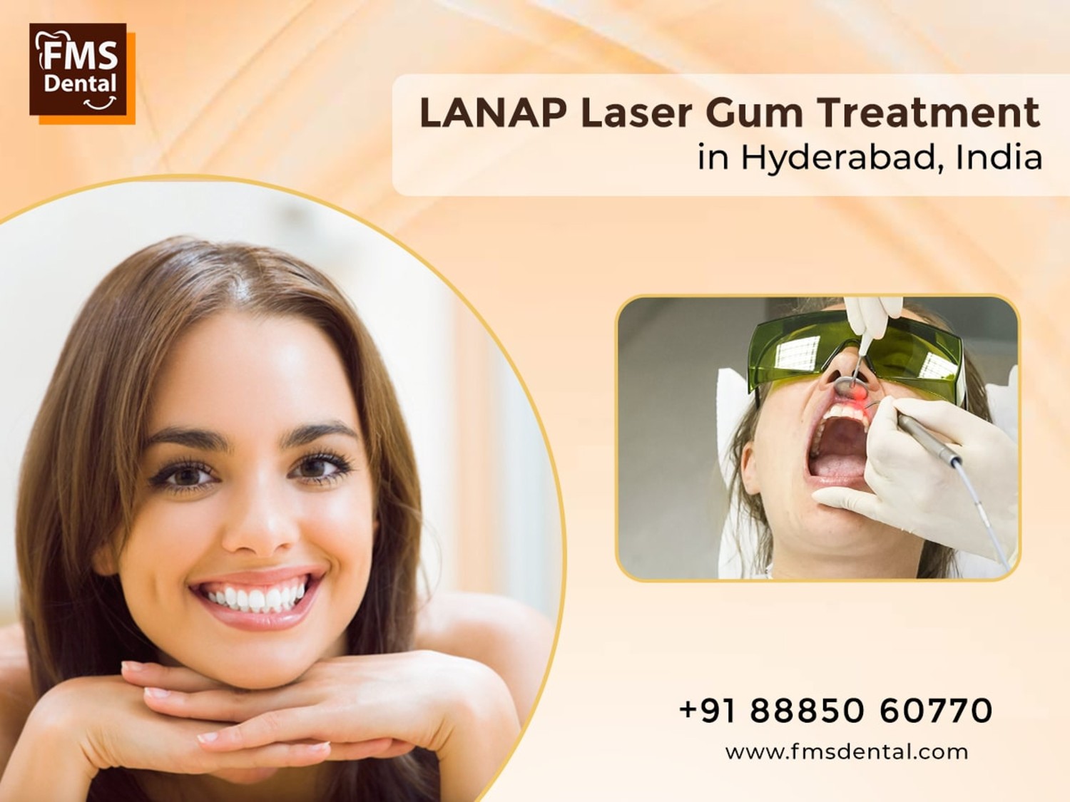LANAP Gum Treatment in Hyderabad, India | LANAP Treatment in India, Hyderabad
