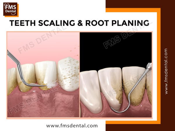 Teeth Scaling and Cleaning in Hyderabad, India | Root Planing Treatment in Hyderabad