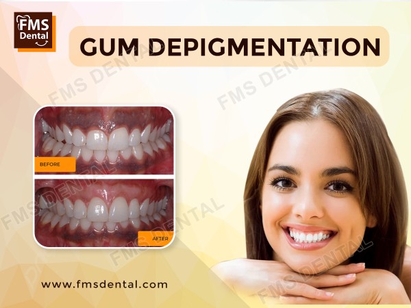Best Gum Treatment in Hyderabad, India , Gum Depigmentation in India, Hyderabad